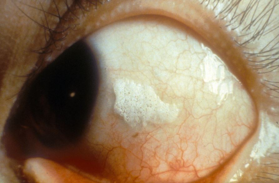 Az A-vitamin hiányának hatása a szemre