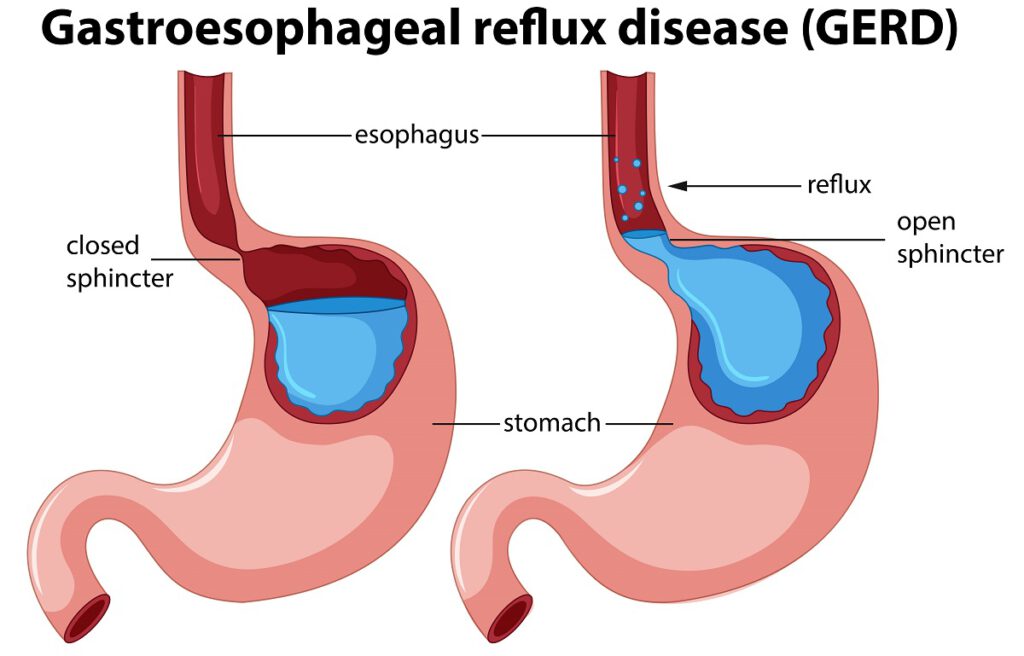 reflux betegség anatómiai illusztrációja